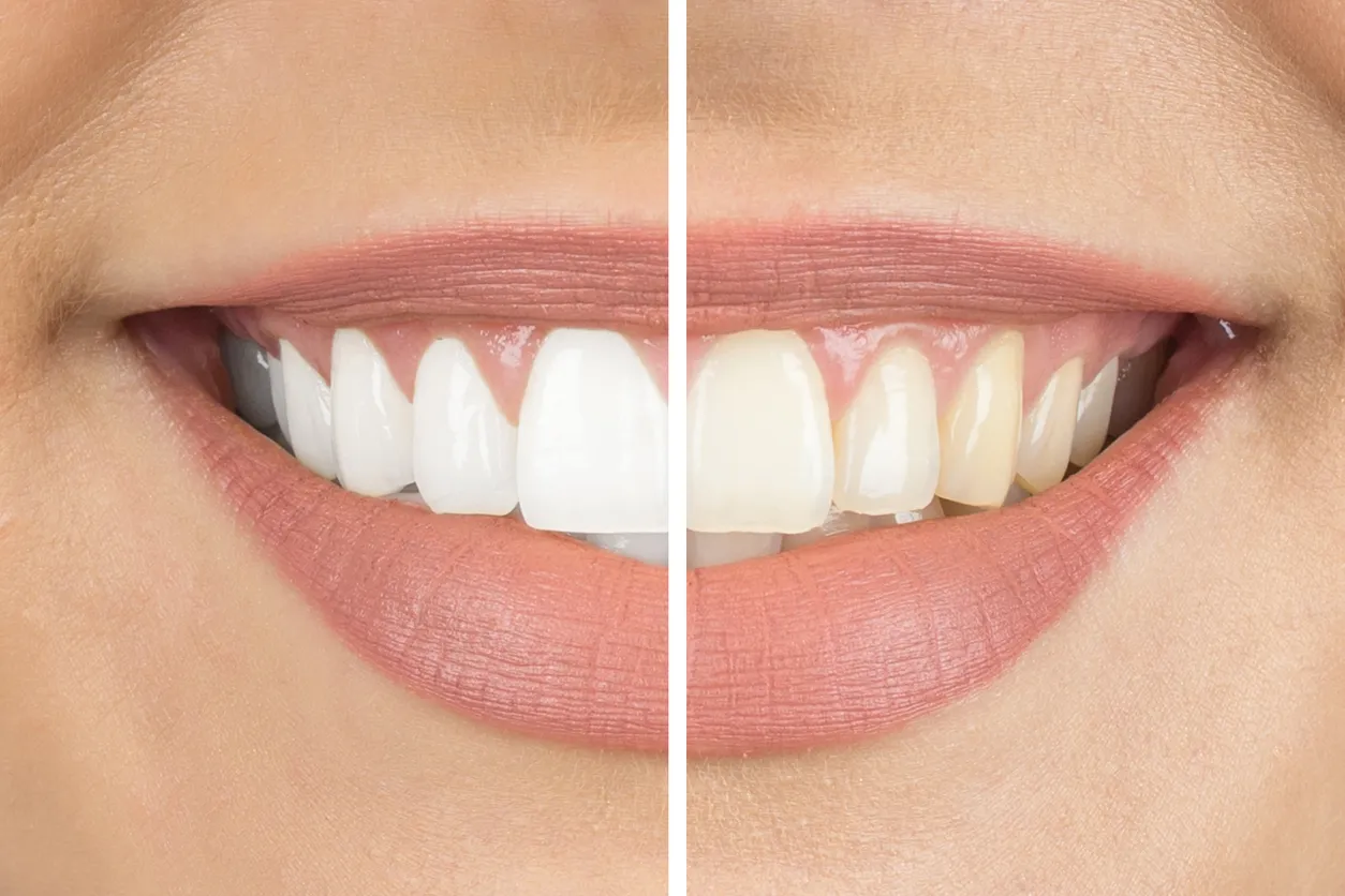 Tips to Maintain Your Smile After Teeth Whitening