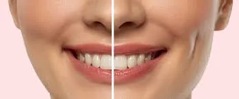Best Dimple Creation Surgery: Enhance Your Smile with Natural Dimples