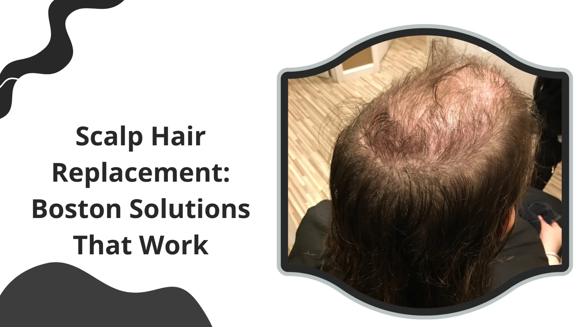 Scalp Hair Replacement: Boston Solutions That Work