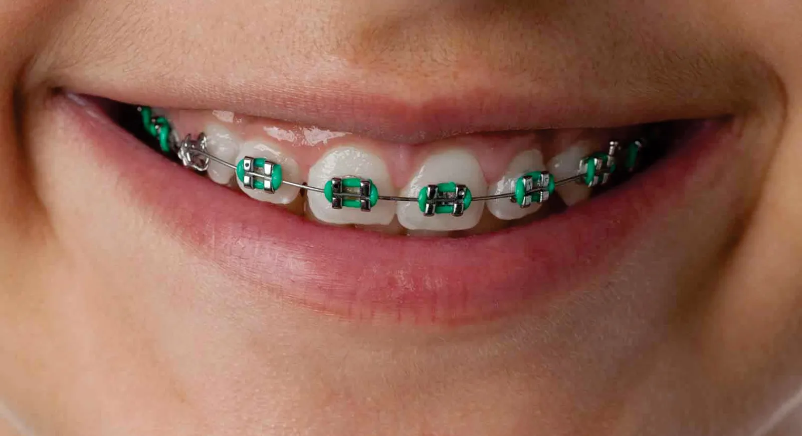 Digital Orthodontics Explained: Faster and More Accurate Braces Treatment