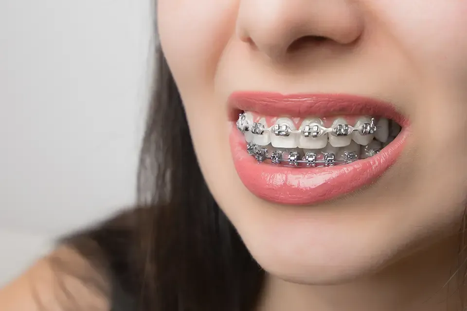 Braces for Adults : Ceramic Braces vs Metal Braces