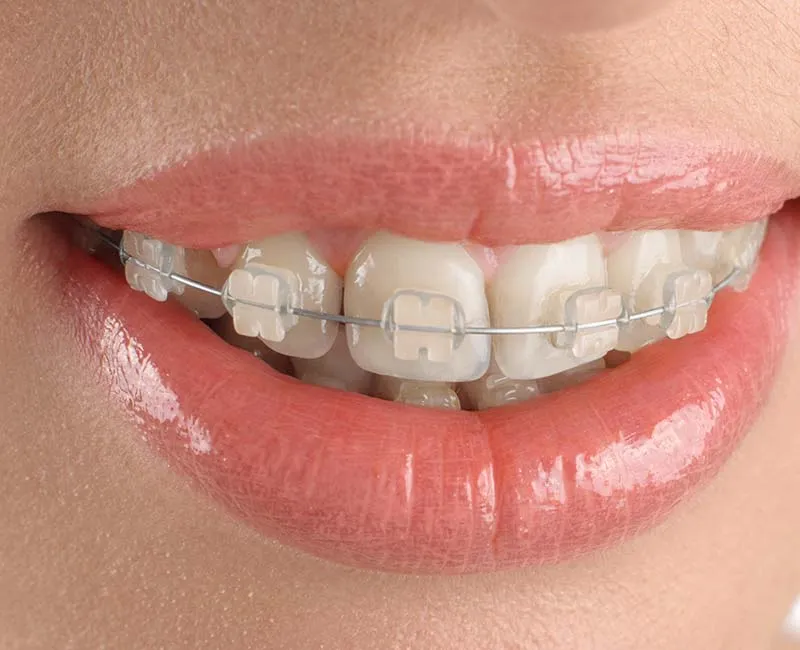 Braces for Adults : Ceramic Braces vs Metal Braces