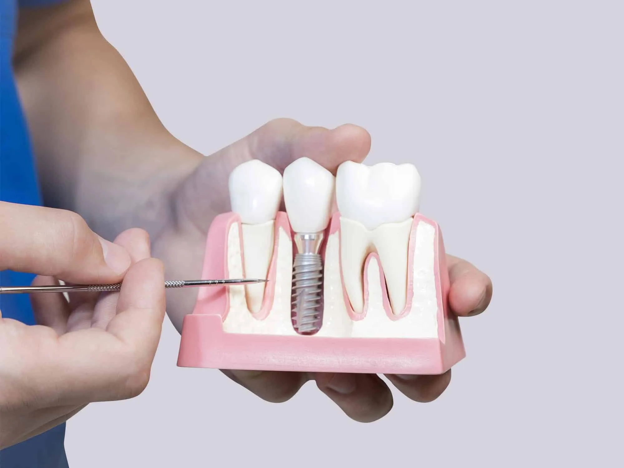 What Is the Recovery Time After Teeth Implant Surgery?