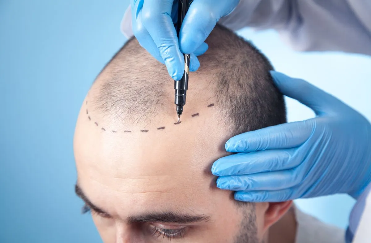 Why FUE Hair Transplant in Hyderabad Is The Best Treatment for Natural Hair Restoration?