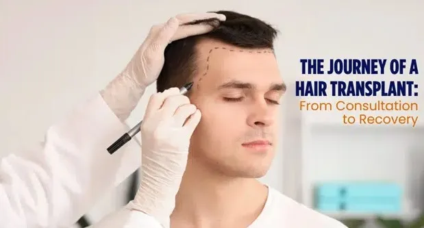 Hair Transplant in Delhi for Beard and Eyebrow Restoration