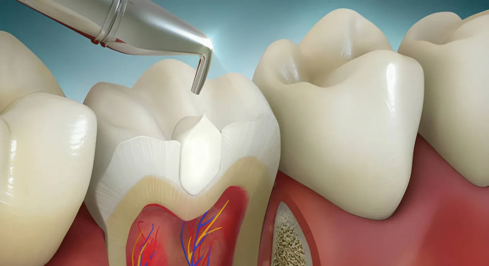Laser Root Canal Treatment for Advanced and Painless Dental Care