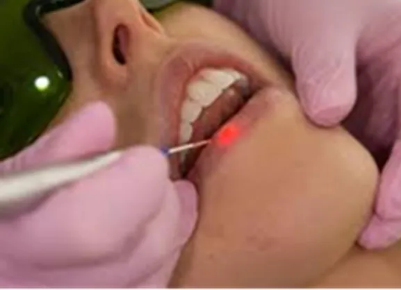 Stop Cold Sore Pain with Laser Dental Treatment