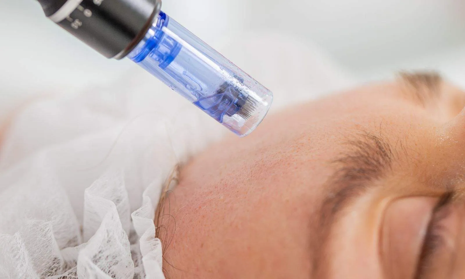 Microneedling Treatment: Why More Patients Are Choosing It for Natural Skin Rejuvenation
