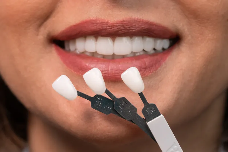 Composite Veneers Brisbane for a Fresh and Youthful Appearance