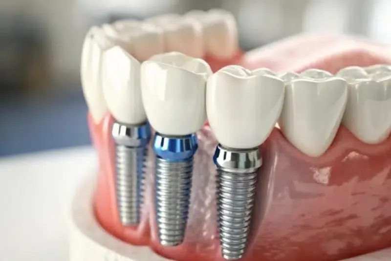 Dental Implants for Missing Back Teeth: Brisbane's Most Overlooked Solution