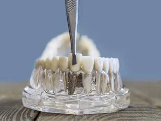 Dental Implants for Missing Back Teeth: Perth's Most Overlooked Solution
