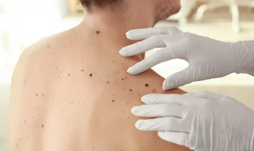 Mole Removal Near Me: Trusted Professionals for Expertises