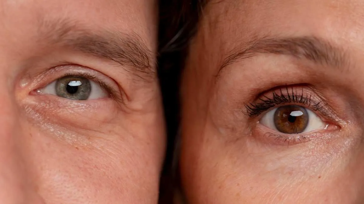 What Causes Under Eye Bags and Sagging Eyelids?