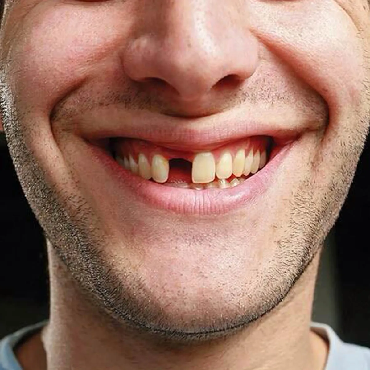 Top Ways Missing Tooth Replacement Improves Oral Health and Confidence
