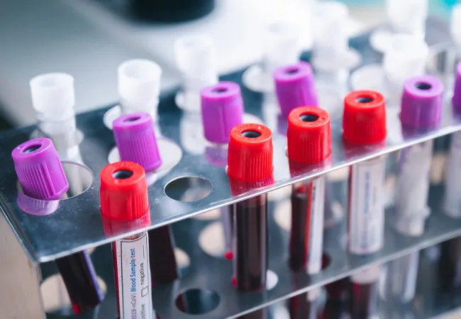 Why Researchers Need High-Quality Membranous Nephropathy Serum Samples
