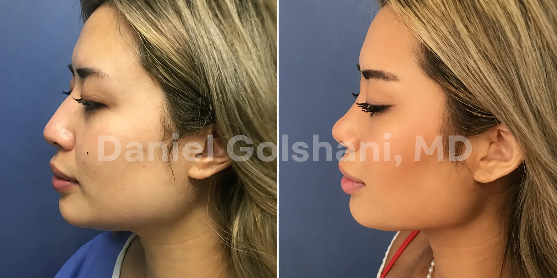 Ethnic Rhinoplasty - Changing Your Nose Without Losing Your Identity