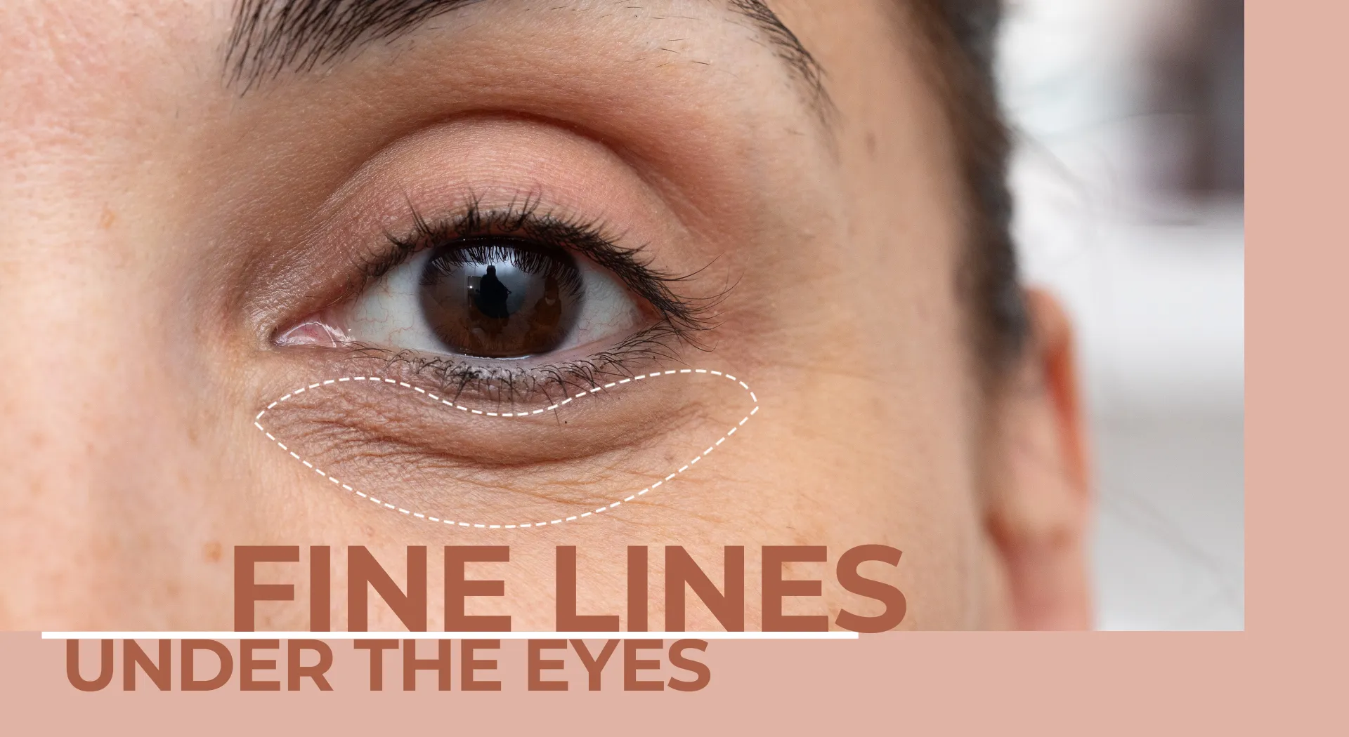 Fine Lines Under the Eyes: Why They Appear Earlier Than You Think