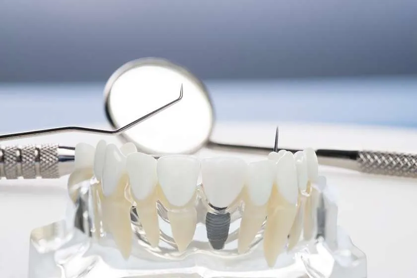 how dental implants work