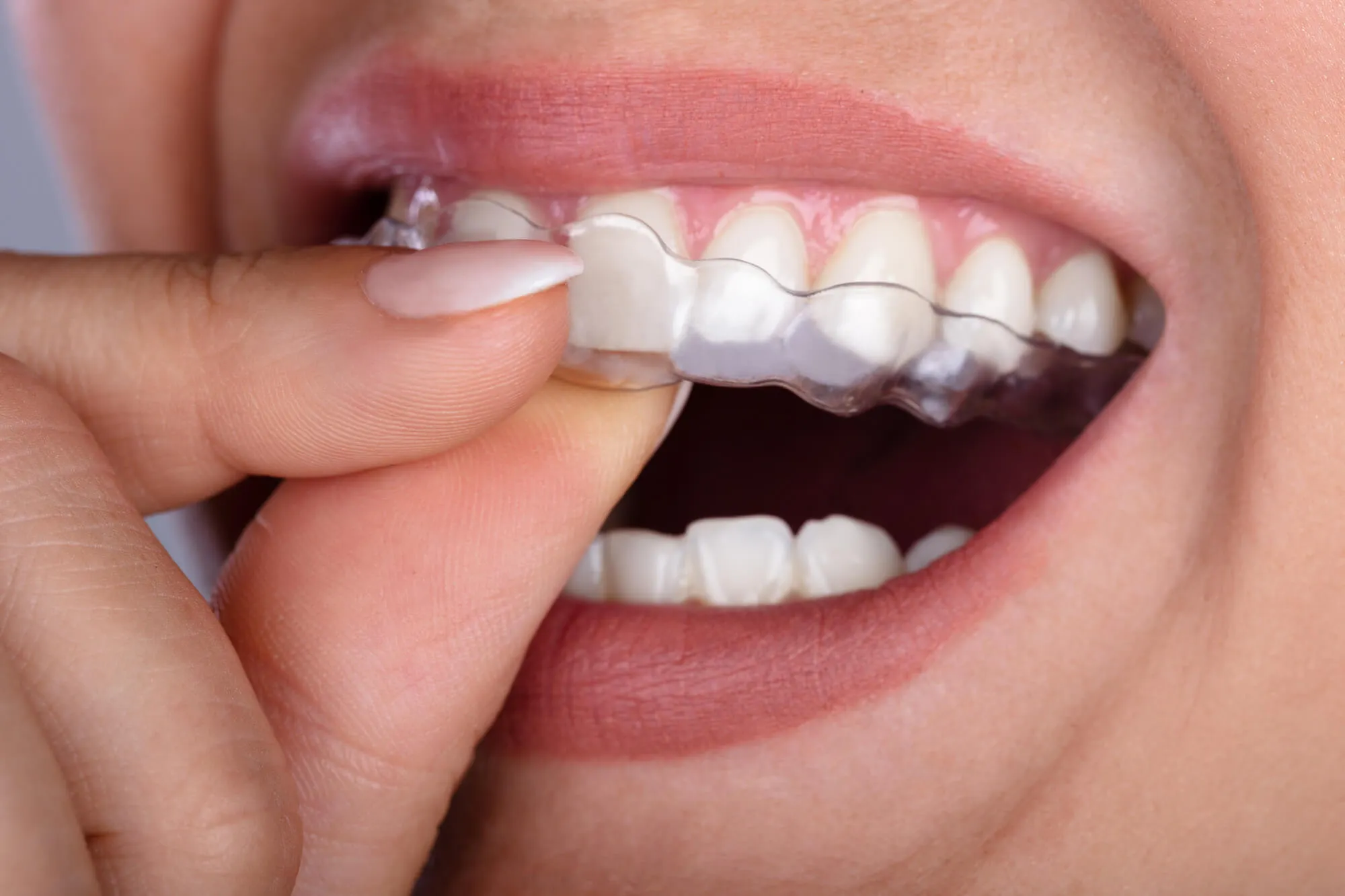 Professional Invisalign Services Available in Las Cruces