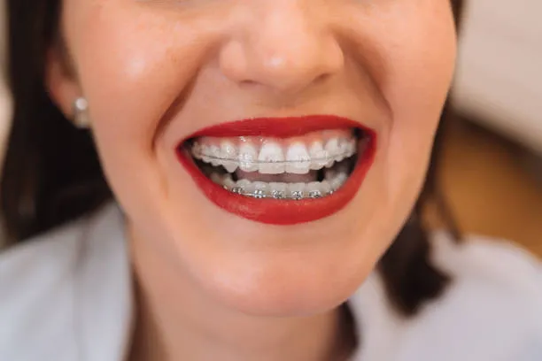 Maintaining Oral Hygiene with Braces: Tips and Tricks