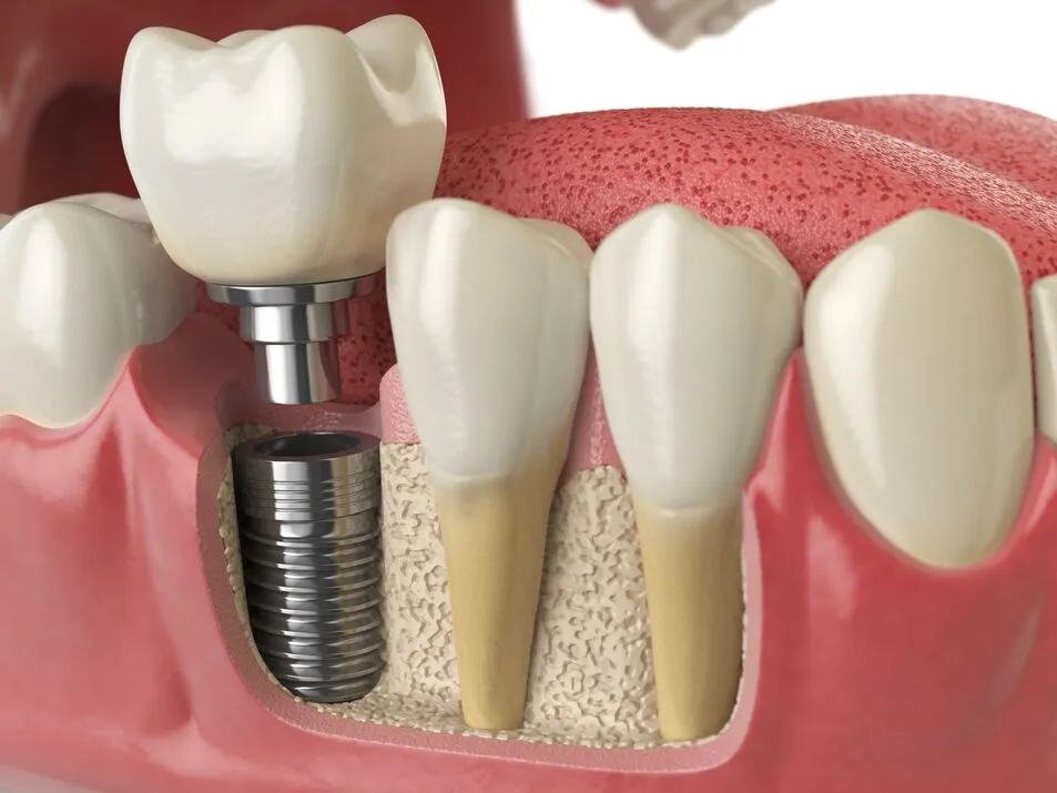 Top Things to Know Before Getting Dental Implants