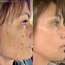 Can Cosmelan Treatment Improve Uneven Skin Tone?