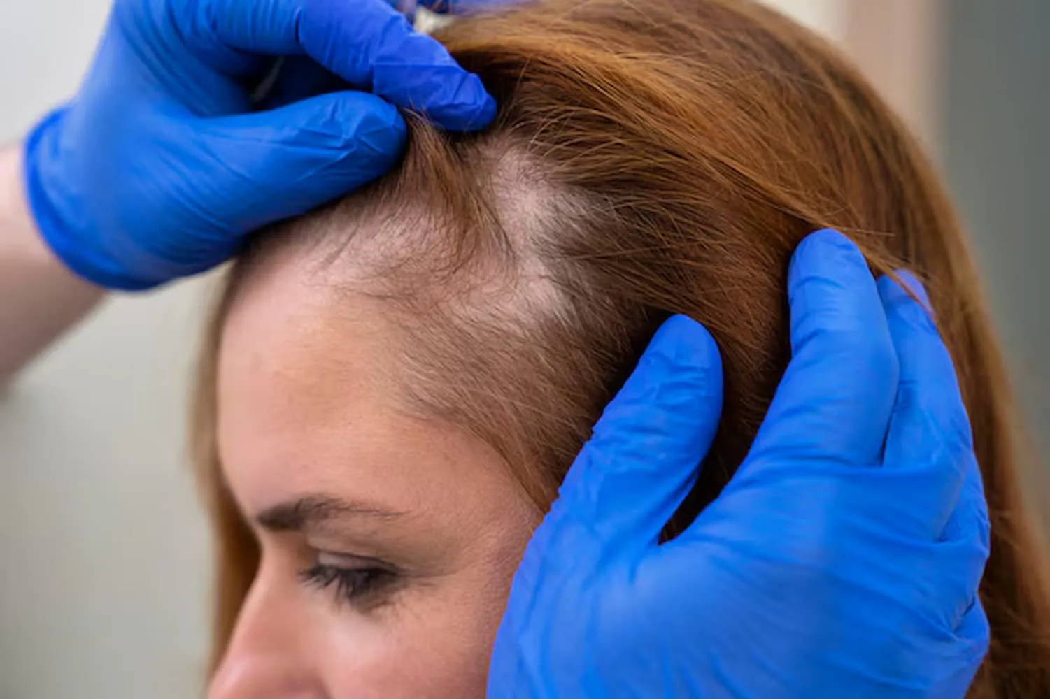 How Alopecia Treatment in Bristol Supports Hair Regrowth