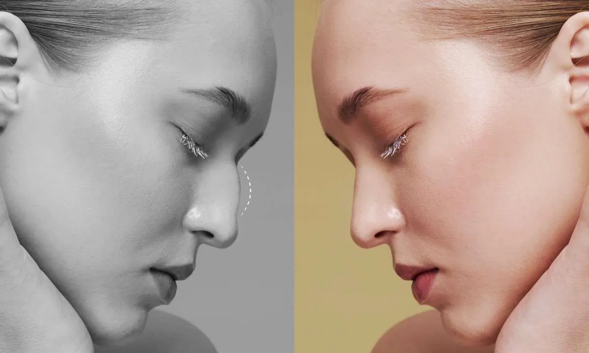 How Long Do Rhinoplasty Results Last?