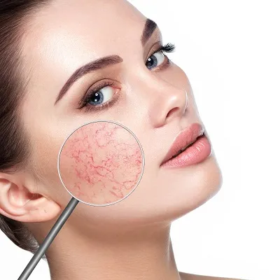 Rosacea Treatment Twickenham For Calm Healthy Skin