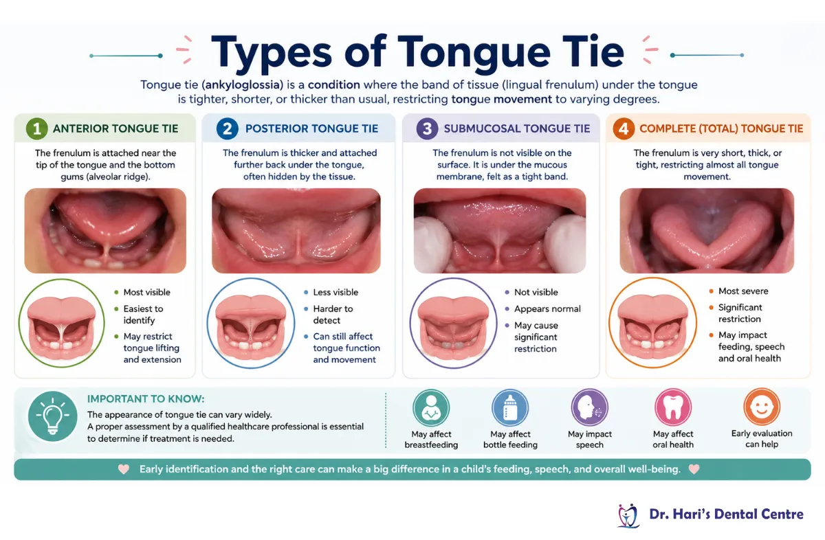 Tongue-Tie Procedure