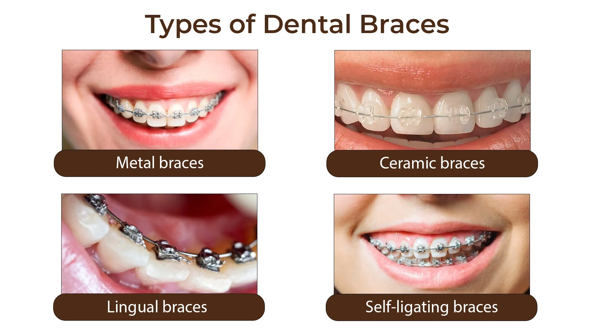 Dental Braces: Types & How They Work