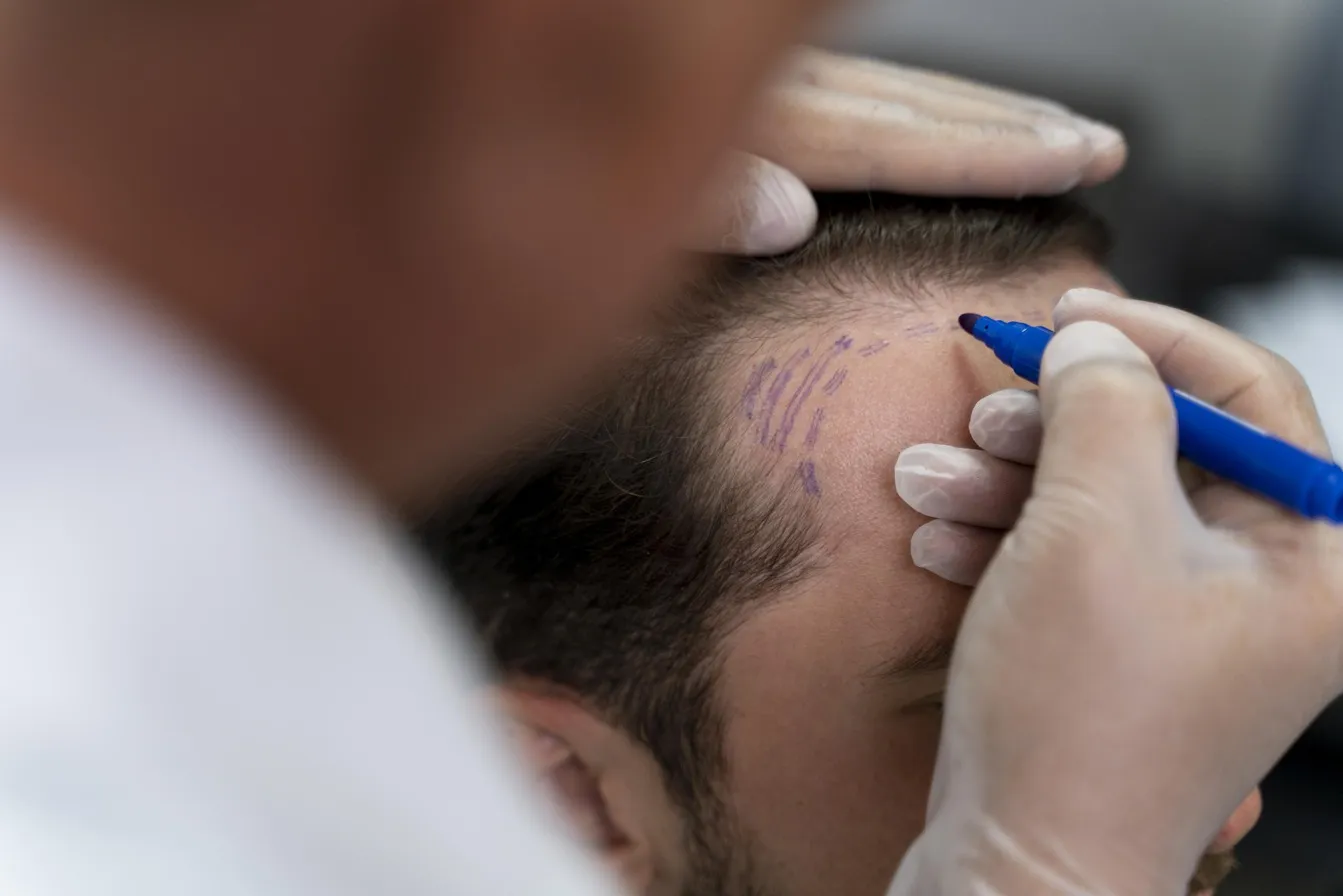 Hairline tattooing: A complete guide to natural-looking results