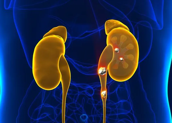 Kidney Stone Treatment in Gurgaon