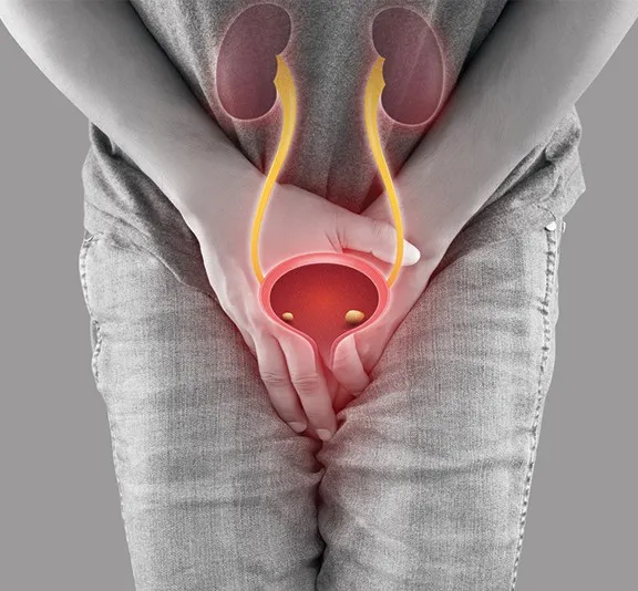 Bladder Stone Treatment in Gurgaon