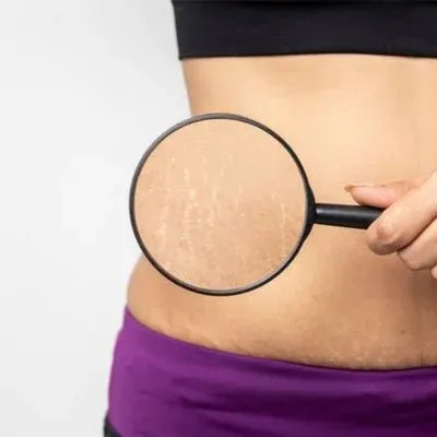 Advanced Stretch Marks Treatment in Pune for Healthier Looking Skin