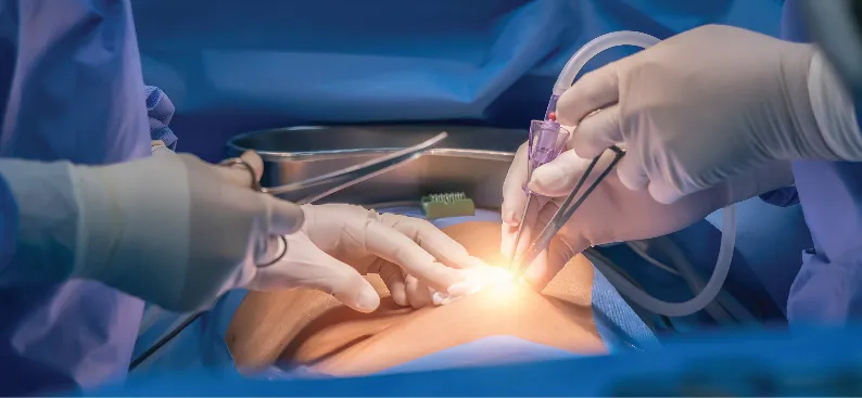 What is HIPEC (Hyperthermic Intraperitoneal Chemotherapy)?