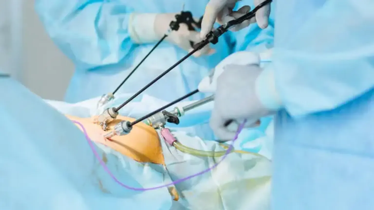 Laparoscopic Colorectal Cancer Surgery in India