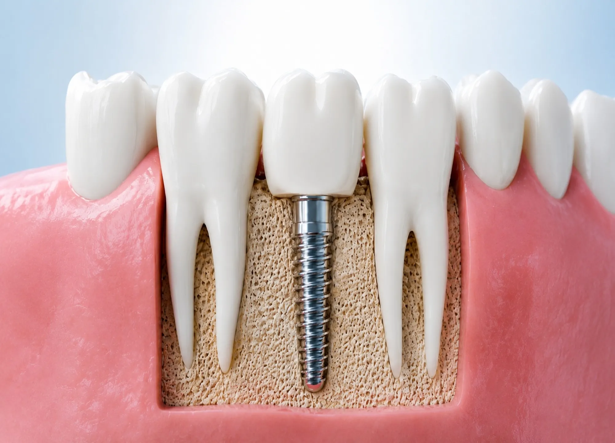 Permanent Dental Implants | Restore Your Missing Teeth Confidently