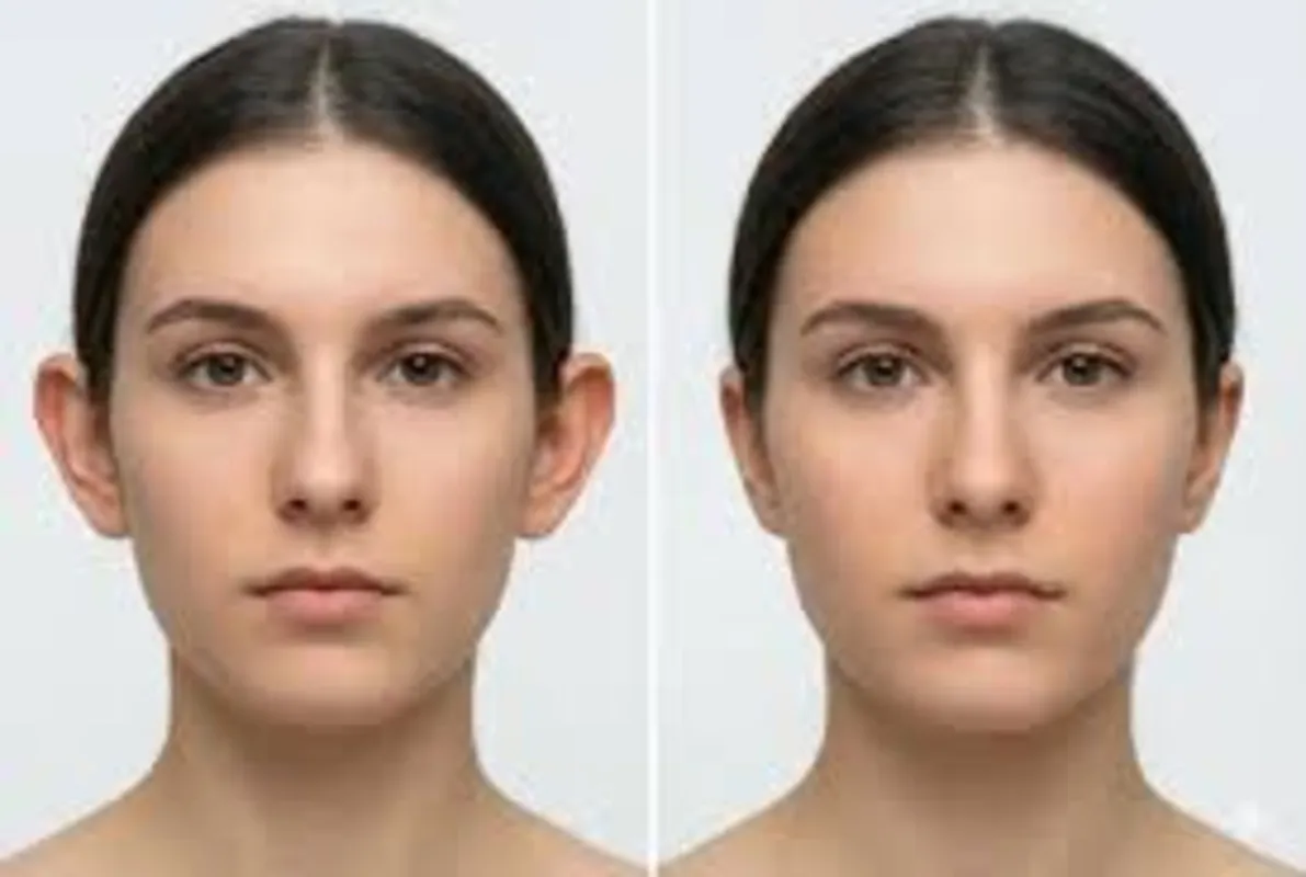Ear Surgery in Dubai: Enhancing Ear Shape and Facial Balance