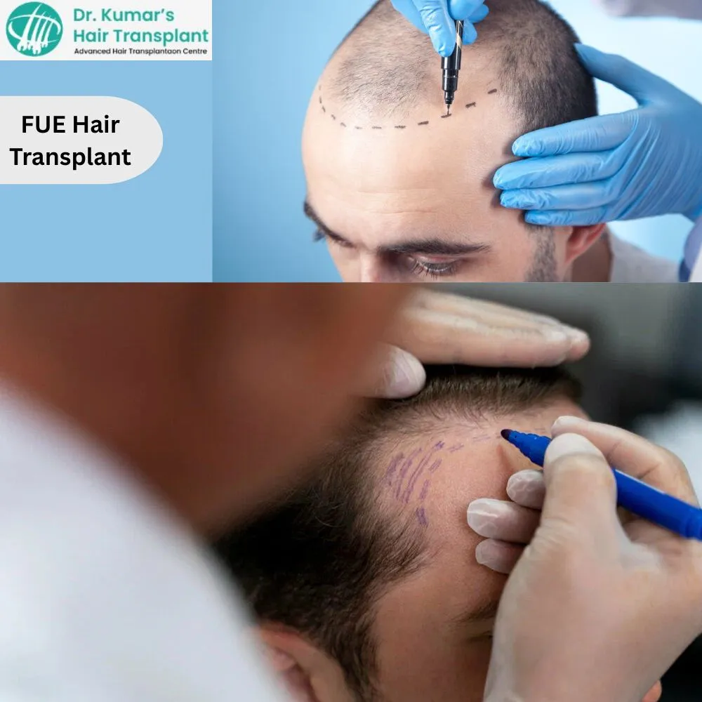 Thinking About a Hair Transplant? Here Is What You Should Know First