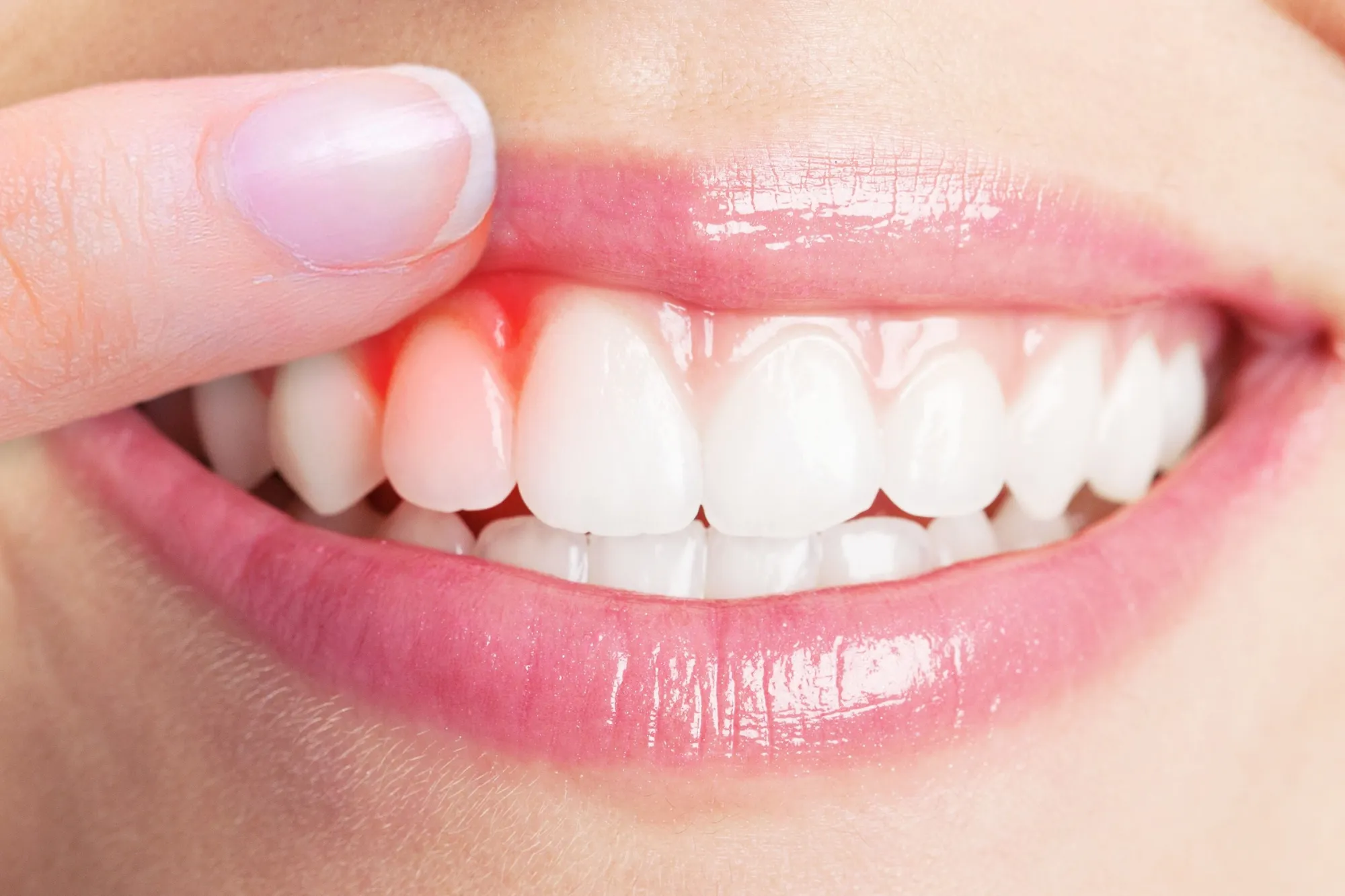 Gum Treatment in Solapur | Bleeding Gums & Periodontal Care – Dr. Shivgunde