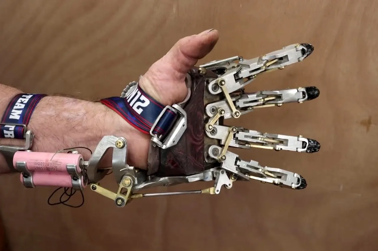 The Rehabilitation Journey After Getting a Body-Powered Prosthetic Arm