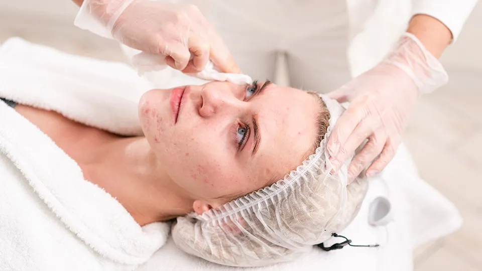 Acne Treatment Guide: Causes, Solutions & Dermatologist Advice