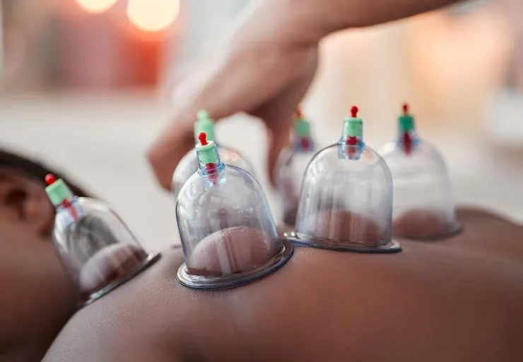 Why Residents in Farringdon Are Choosing Cupping Therapy for Pain Relief