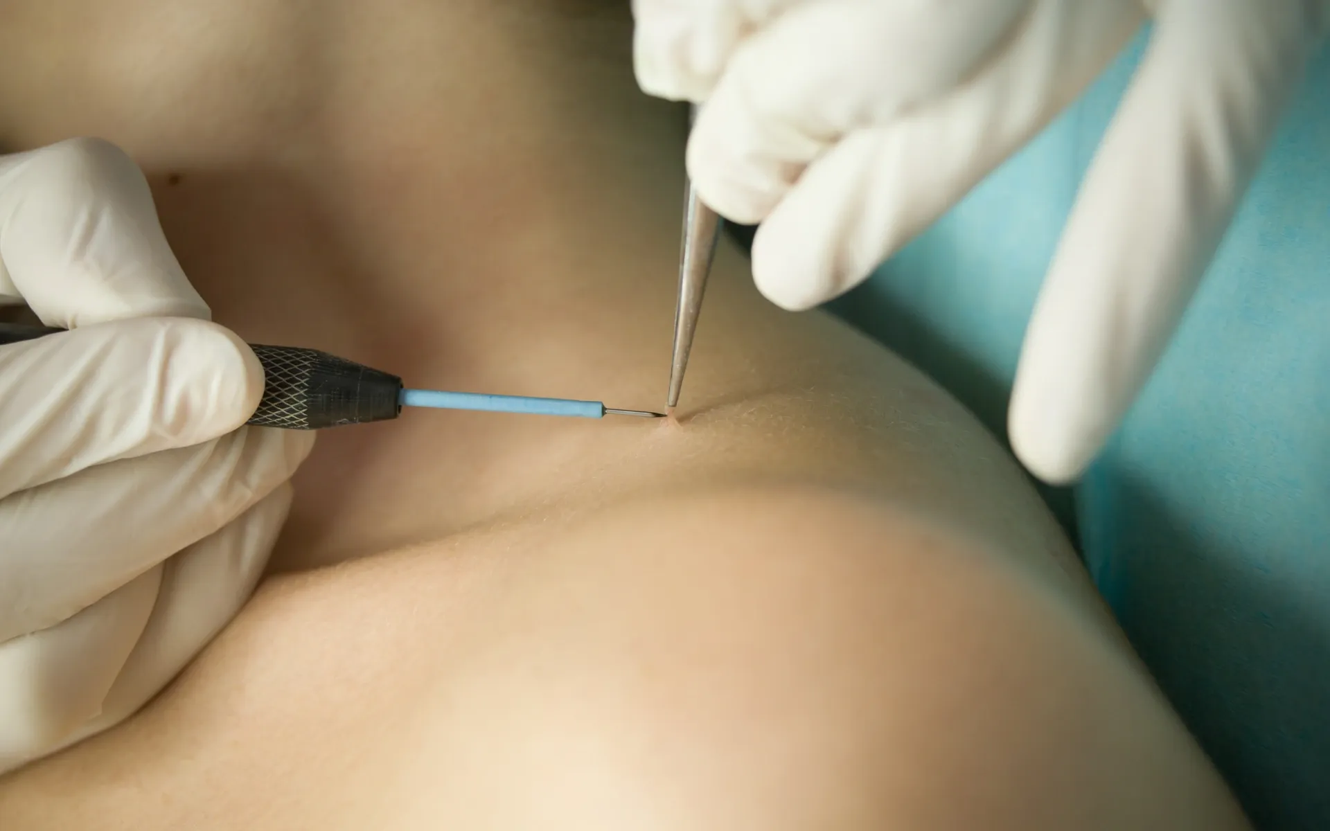 Safe and Effective Skin Tag Removal for Smooth, Clear Skin