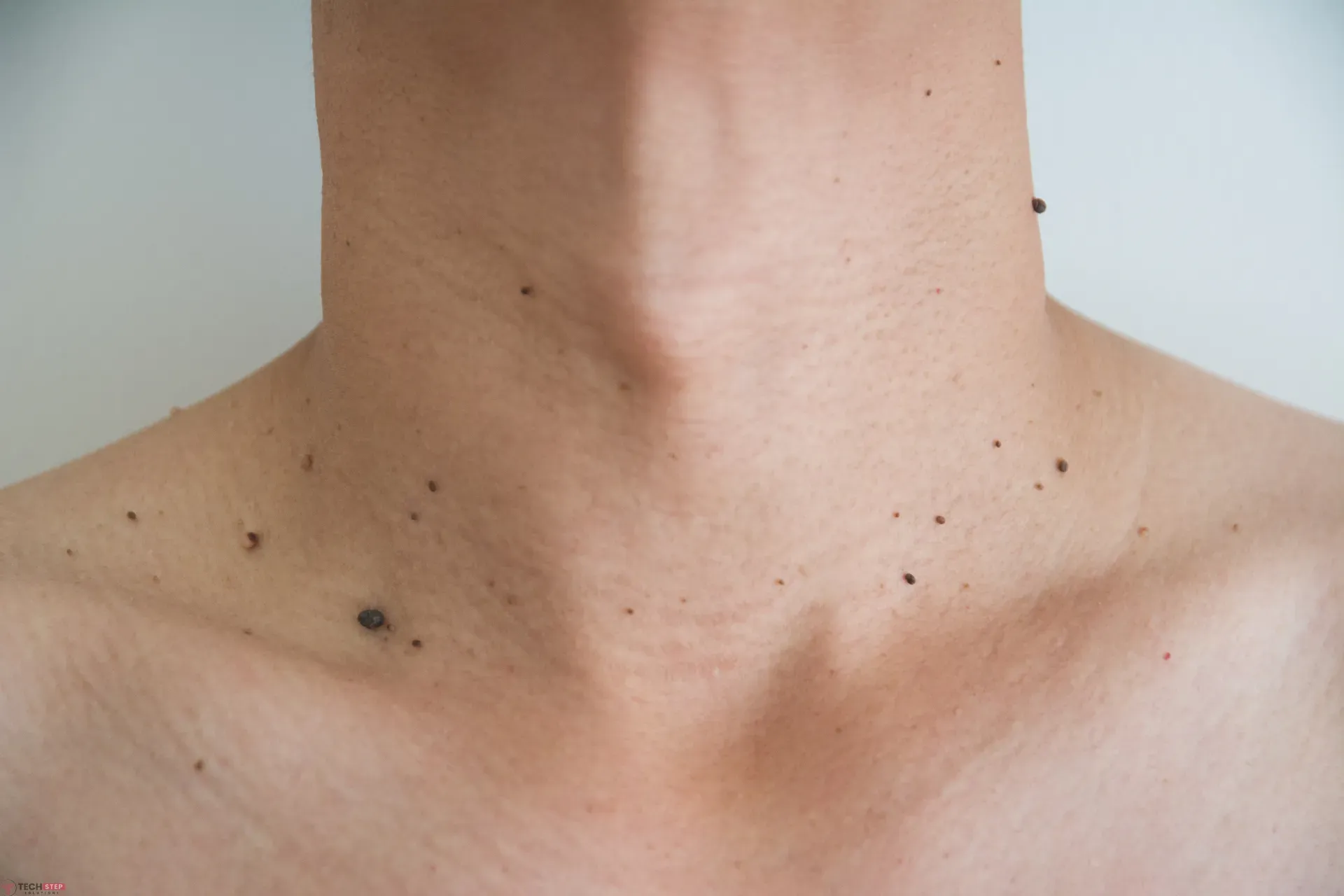 Safe and Effective Skin Tag Removal for Smooth, Clear Skin