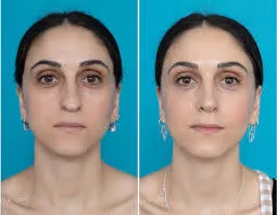 UAE Full Face Fat Transfer Dubai Reality Check