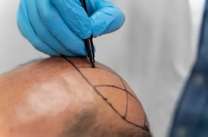 Who Is the Ideal Candidate for FUE Hair Transplant?
