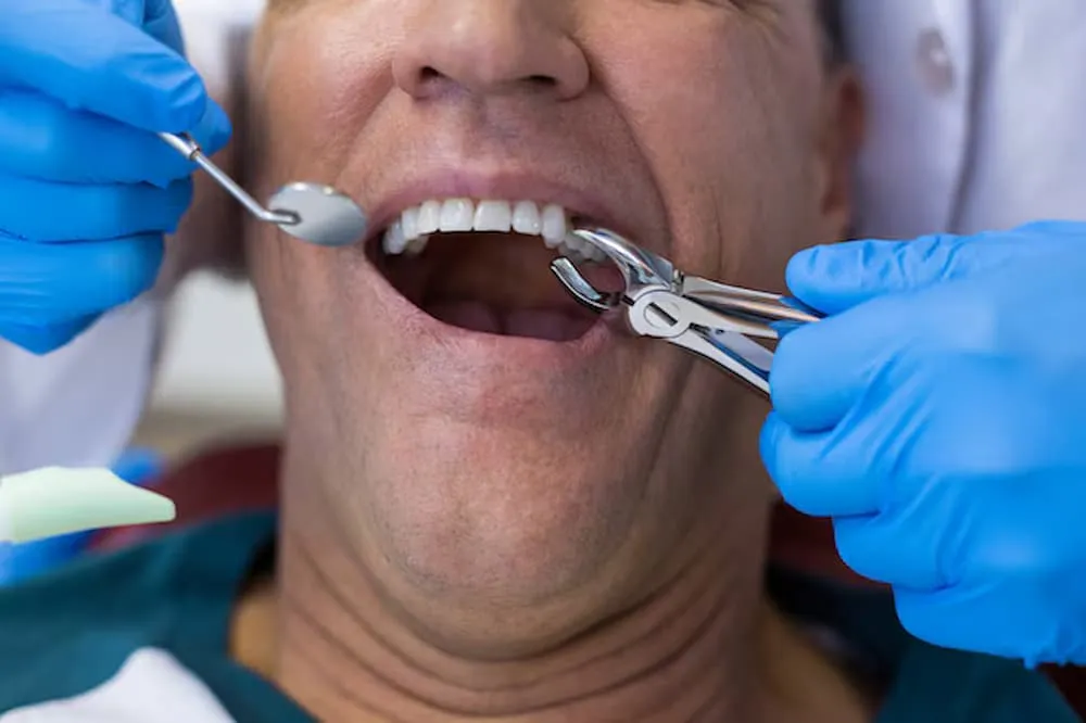 Comfort Focused Treatment Tooth Extraction in Oxnard for Safe Tooth Removal