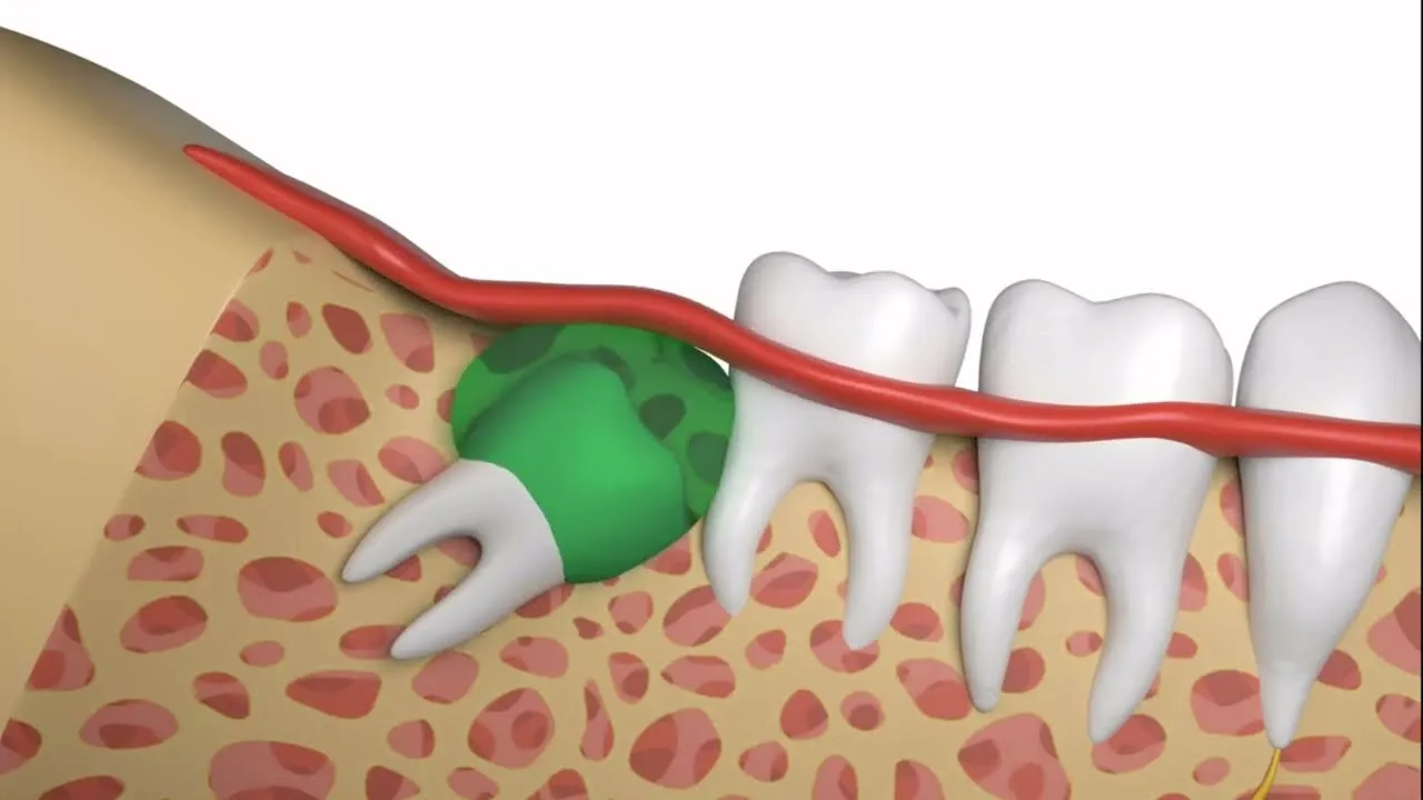 Wisdom Teeth Surgery in Hubli | Shree Vishwa Vande Dental Clinic